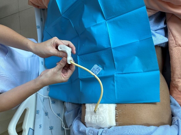 che chở đầu OMTDd bằng gạc bước 6.jpg